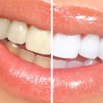 Alum powder for teeth whitening