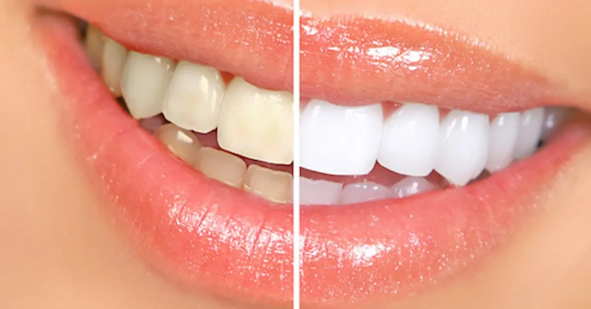 Alum powder for teeth whitening